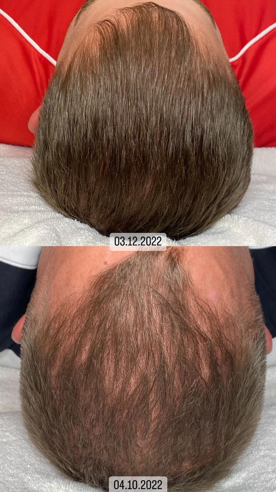 Haarrevitalisierung Kopfhautbehandlung bei Rosamina Beauty nahe Heilbronn